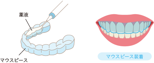 図　医療ホームホワイトニング