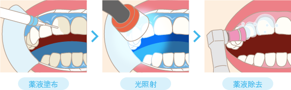 図　医療オフィスホワイトニング
